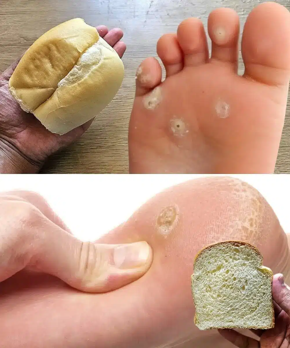 A person applying a moisturizing foot cream to their heel after a home treatment