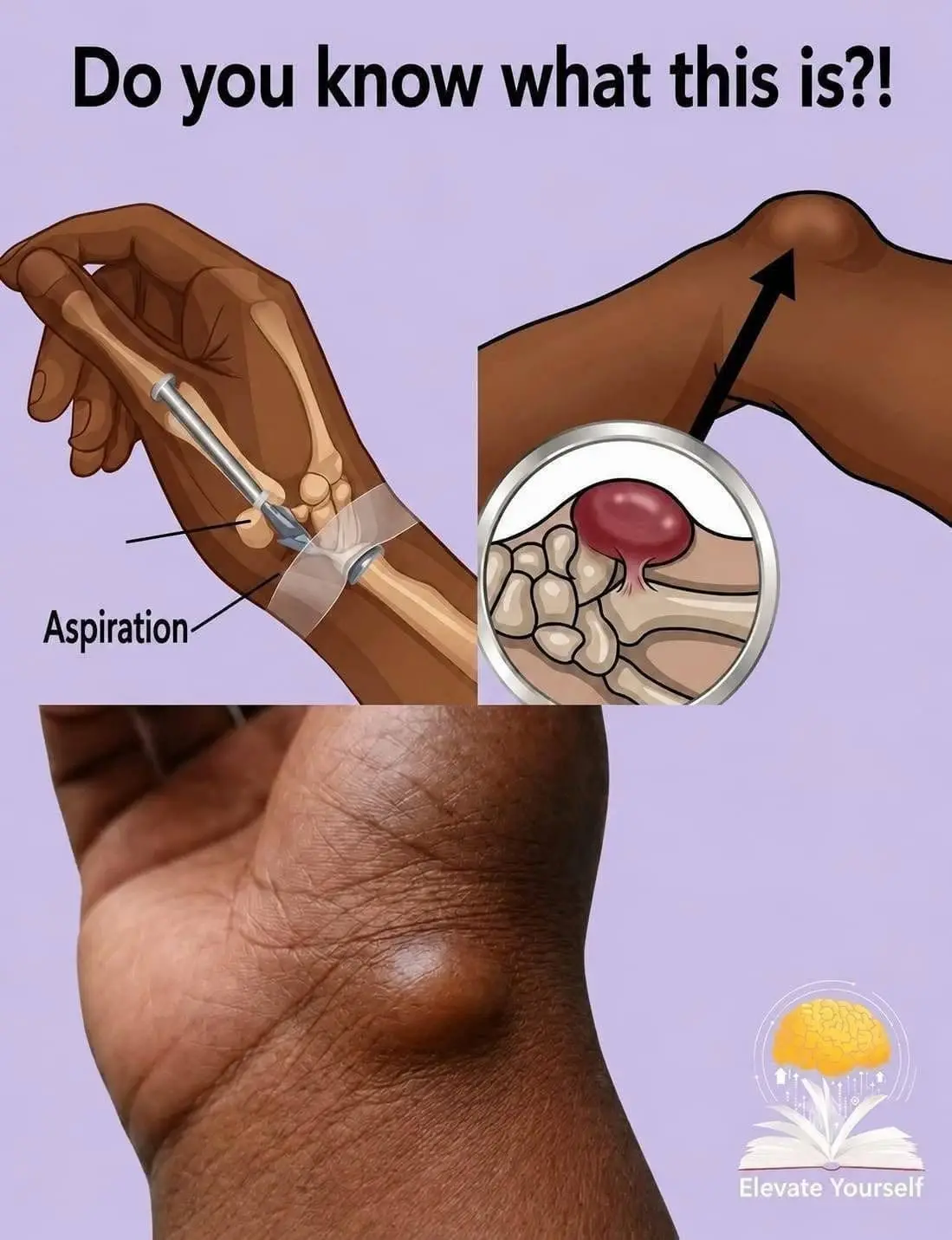 An orthopedic doctor examining a patient's wrist and discussing treatment options for a lump.