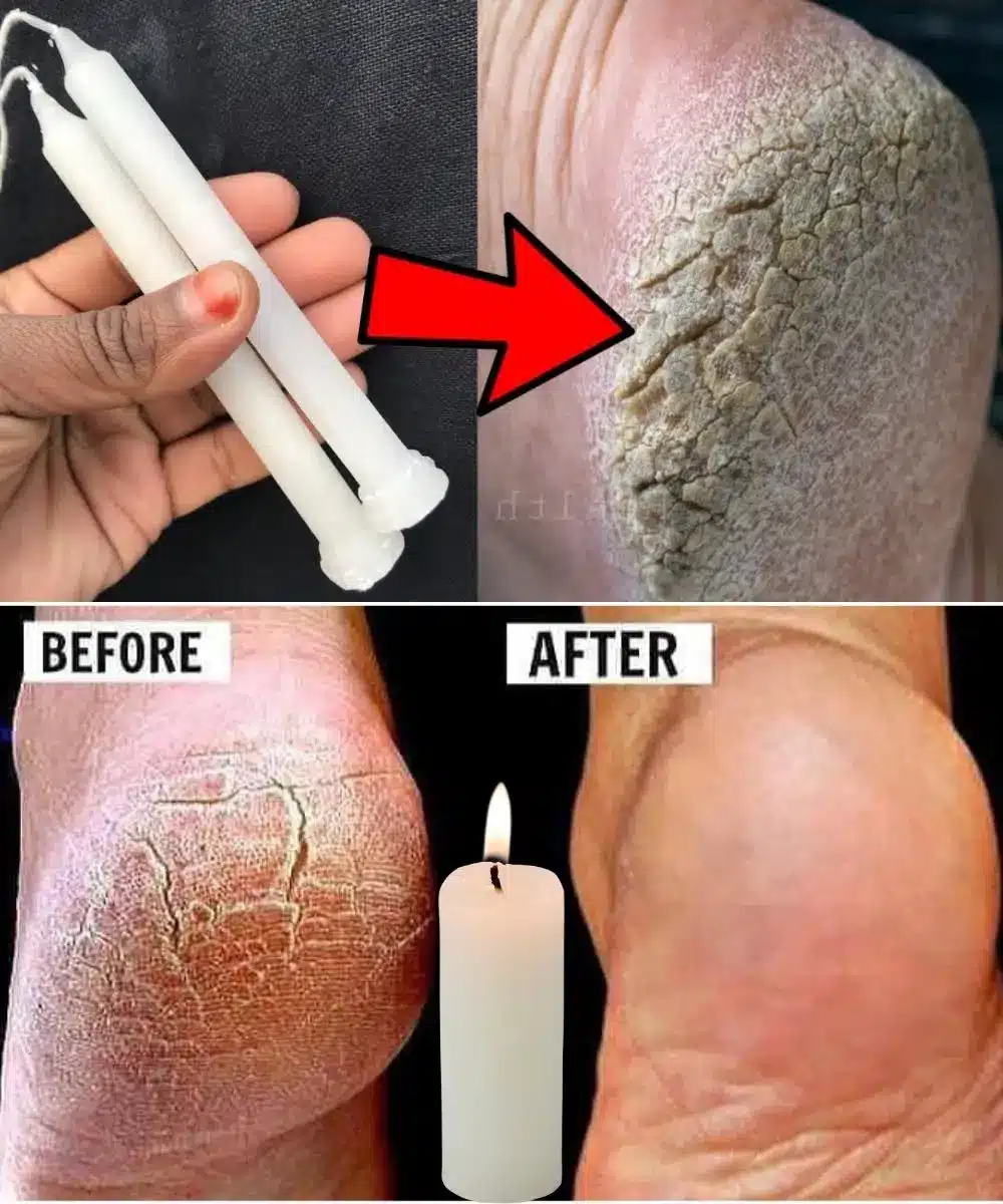 The smooth, soft result of a paraffin wax treatment on a person's heels.
