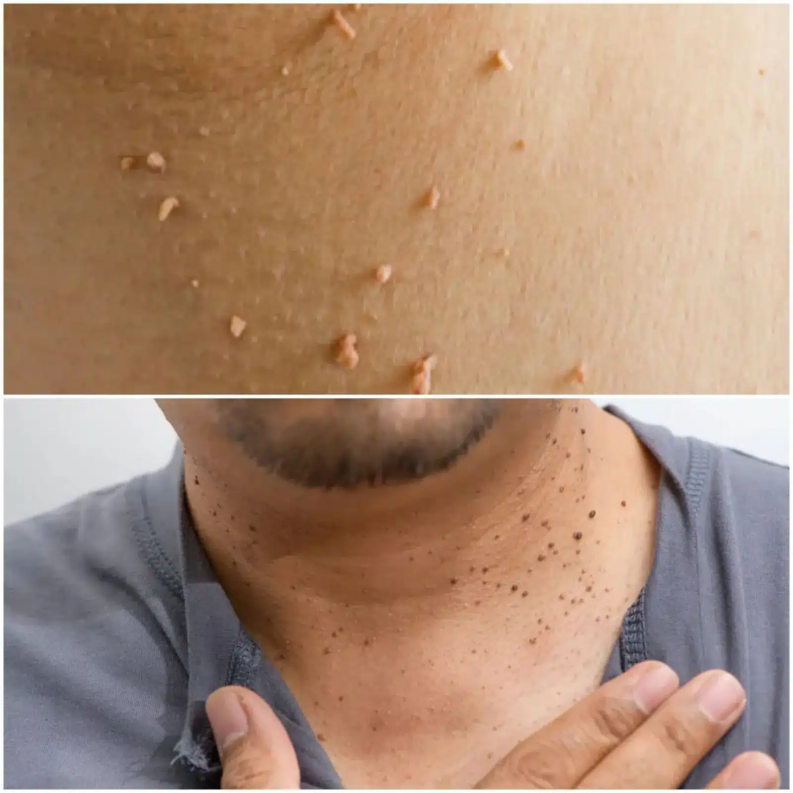 Close up of a person applying topical treatment to a skin blemish